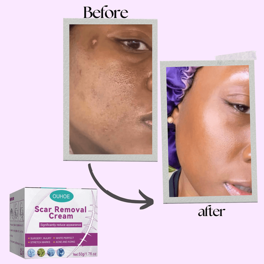Scar Removing Cream – Effective Repair for Clearer Skin Zero side effect